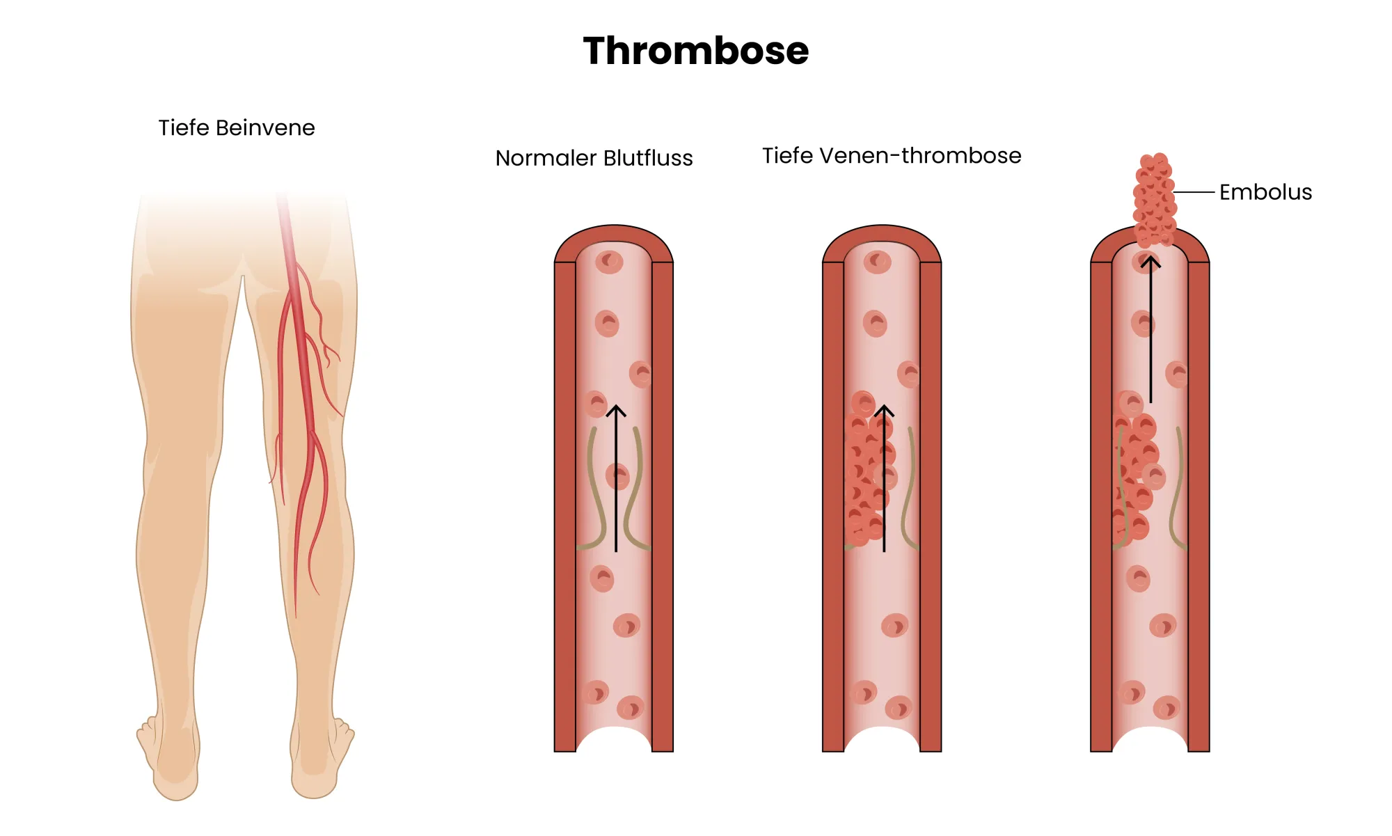 Medizinische Grafik des Ablaufs einer Thrombose