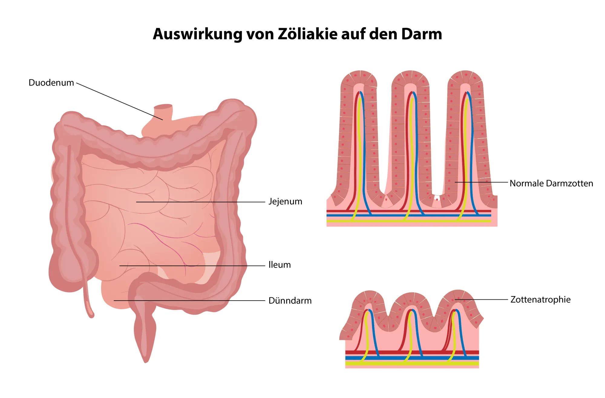 Medizinische Grafik der Auswirkung von Zöliakie auf den Darm