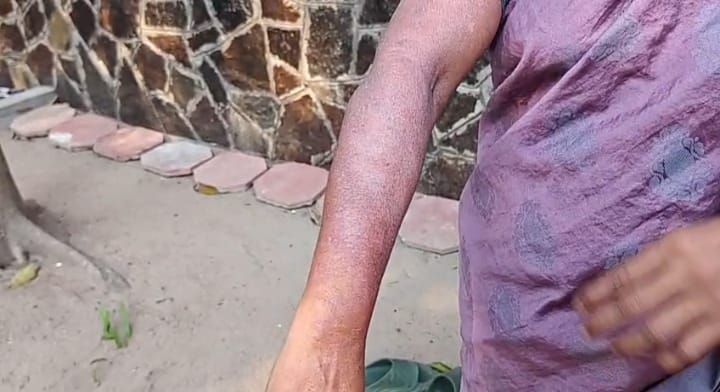 വൈക്കത്ത് വീട്ടമ്മയ്ക്ക് സൂര്യാഘാതമേറ്റു