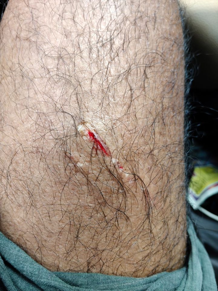 തെരുവ് നായ ആക്രമണത്തിൽ മധ്യമപ്രവർത്തകന് പരുക്ക്