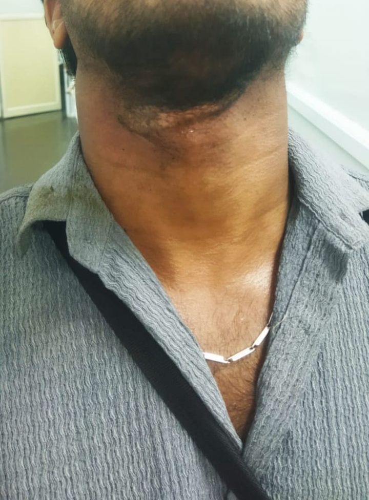 ടോറസ് ലോറി തട്ടി പൊട്ടിവീണ കേബിൾ പിന്നാലെ വന്ന ബൈക്ക് യാത്രക്കാരൻ്റെ കഴുത്തിൽ കുരുങ്ങി പരുക്കേറ്റു