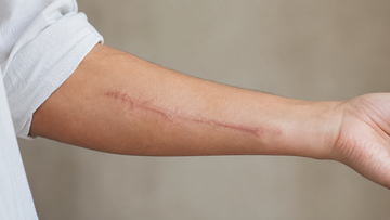 🛑 Weekly Newsletter: Light Therapy's Effects On Different Scars & Optimal Session Timing
