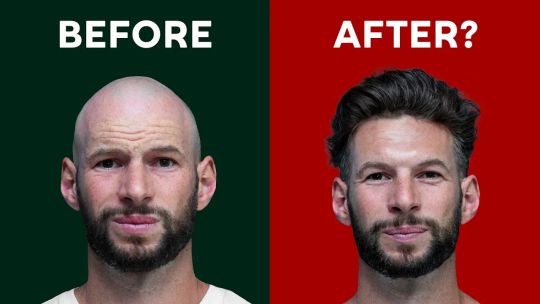 Red Light Therapy For Hair Regrowth: HUGE 6-Month Test!