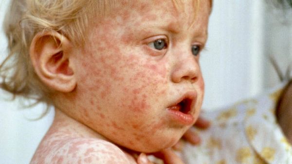 Alabama Sees First Measles Case in 23 Years; Health Officials Urge Parents to Act