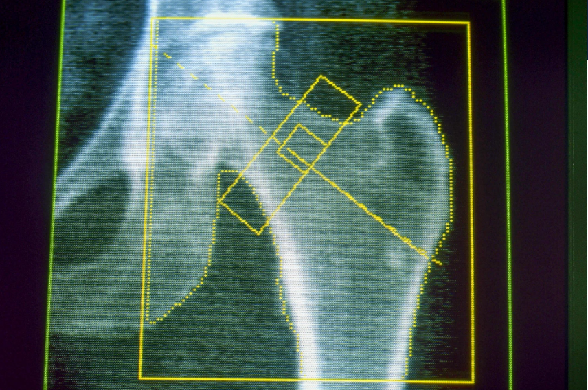 GLP-1s may increase risk of osteoporosis and gout, new research finds