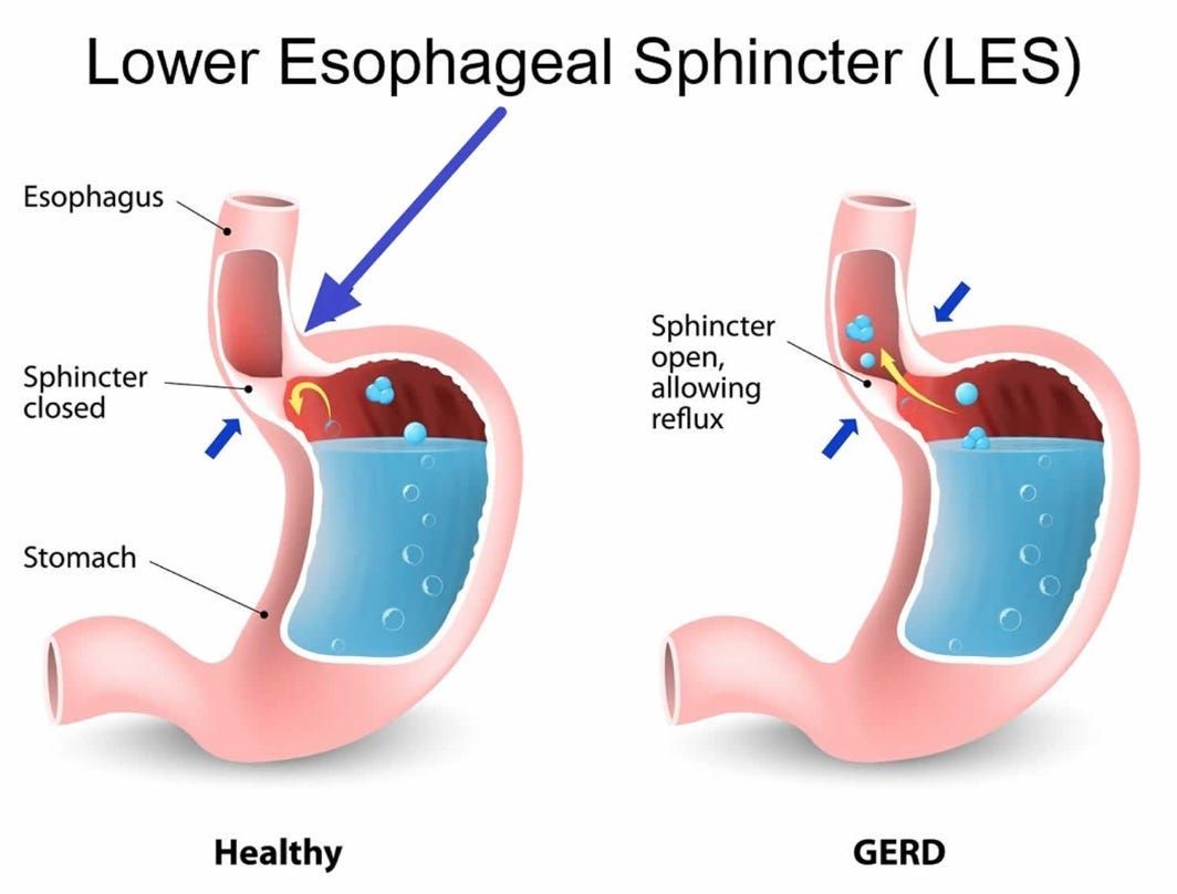 The Great Acid Reflux Scam