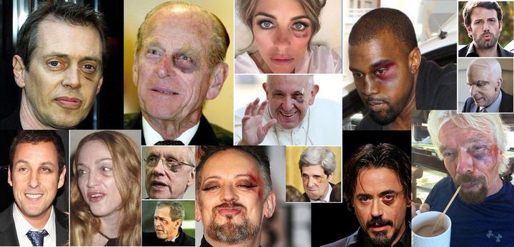 Just What Exactly Is ‘The Black Eye Club,’ And Why Are So Many Celebrities A Part Of It?
