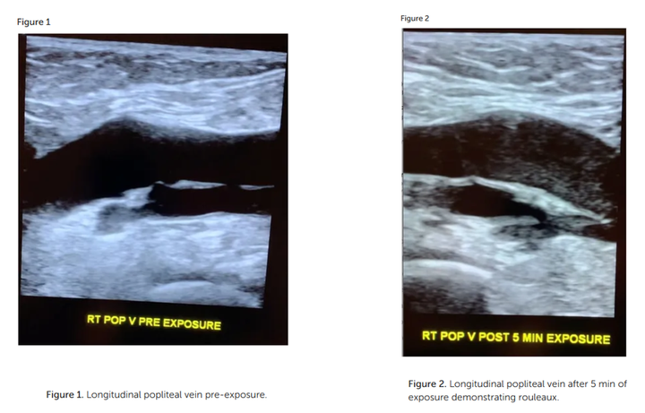 Smart Phone Exposure Shows Rouleaux Formation Via Ultrasound In Large Leg Veins Within Minutes And New Guidelines For Safe Exposure For Kids To Smart Devices - Age 0-6 No Screen Time Is Safe!