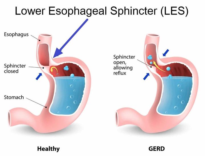 The Great Acid Reflux Scam