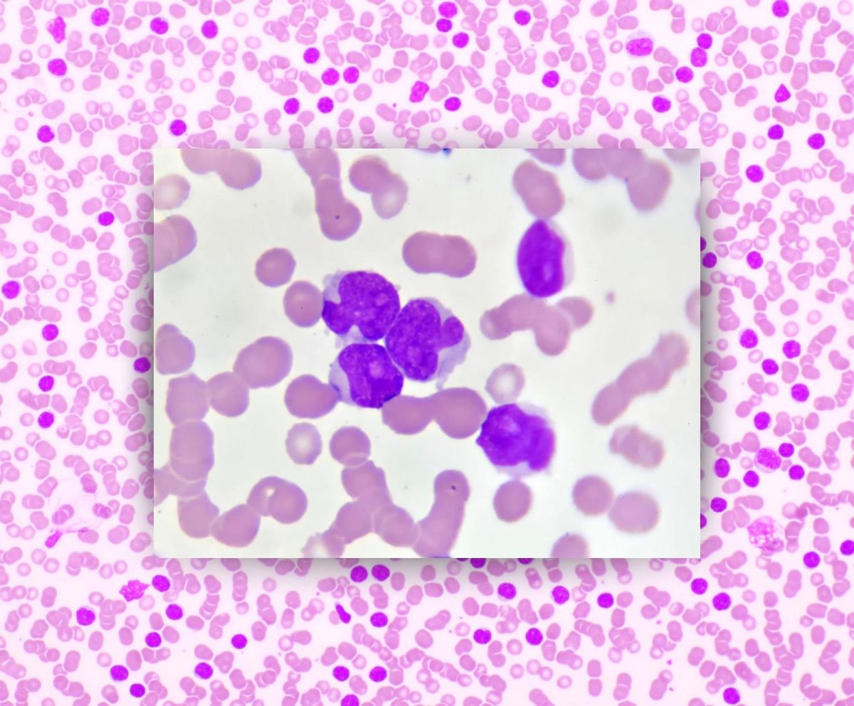 Leukemia 101