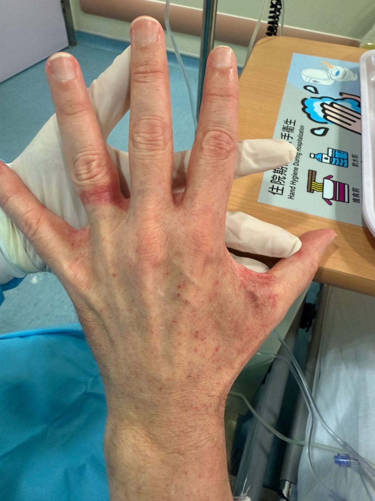 The back of a man’s hand shows lots of small red dots, a graft vs host disease reaction to a stem cell transplant.