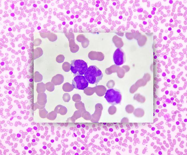 Leukemia 101