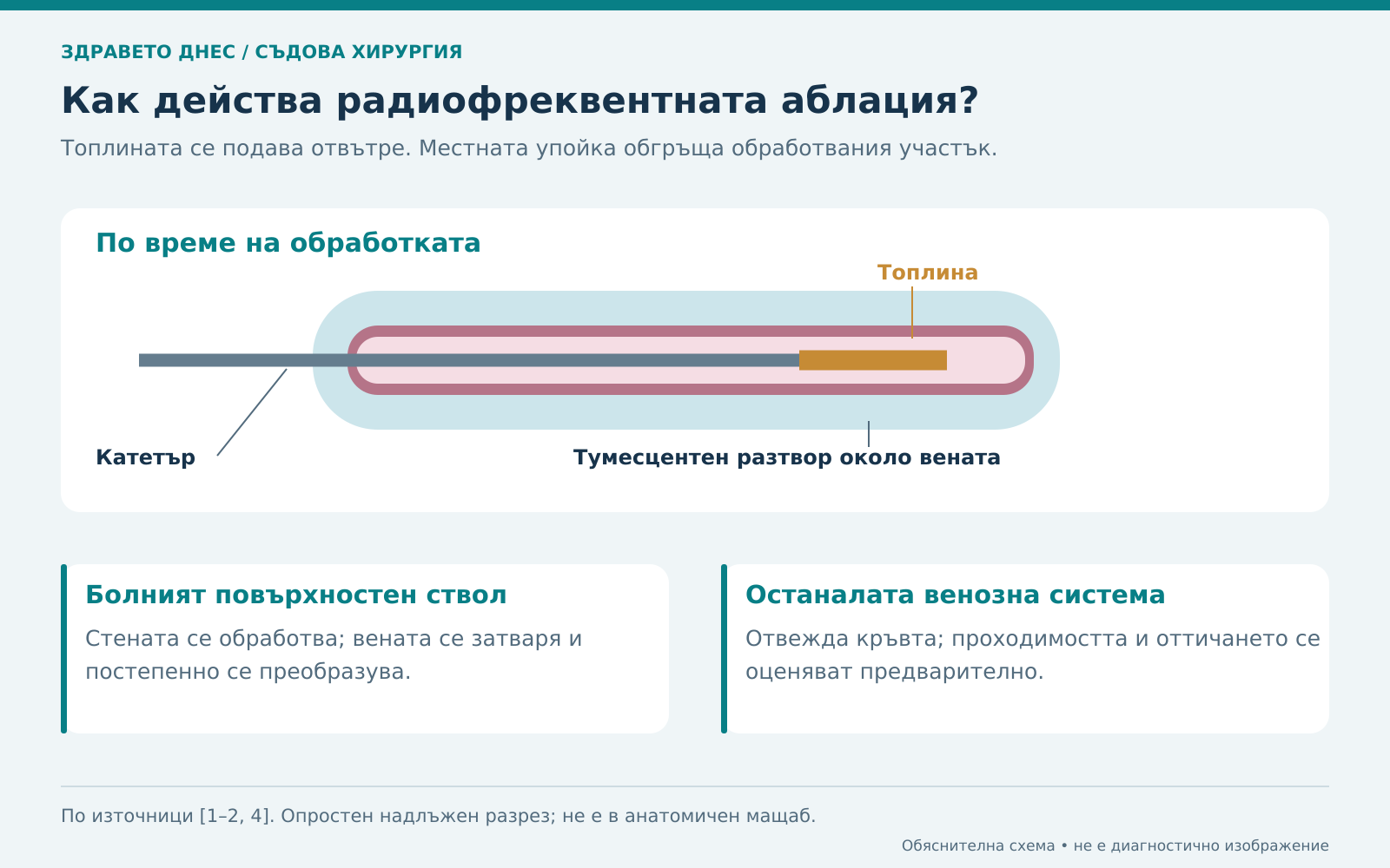 Катетърът подава топлина вътре във вената, а тумесцентният разтвор обгръща обработвания участък.