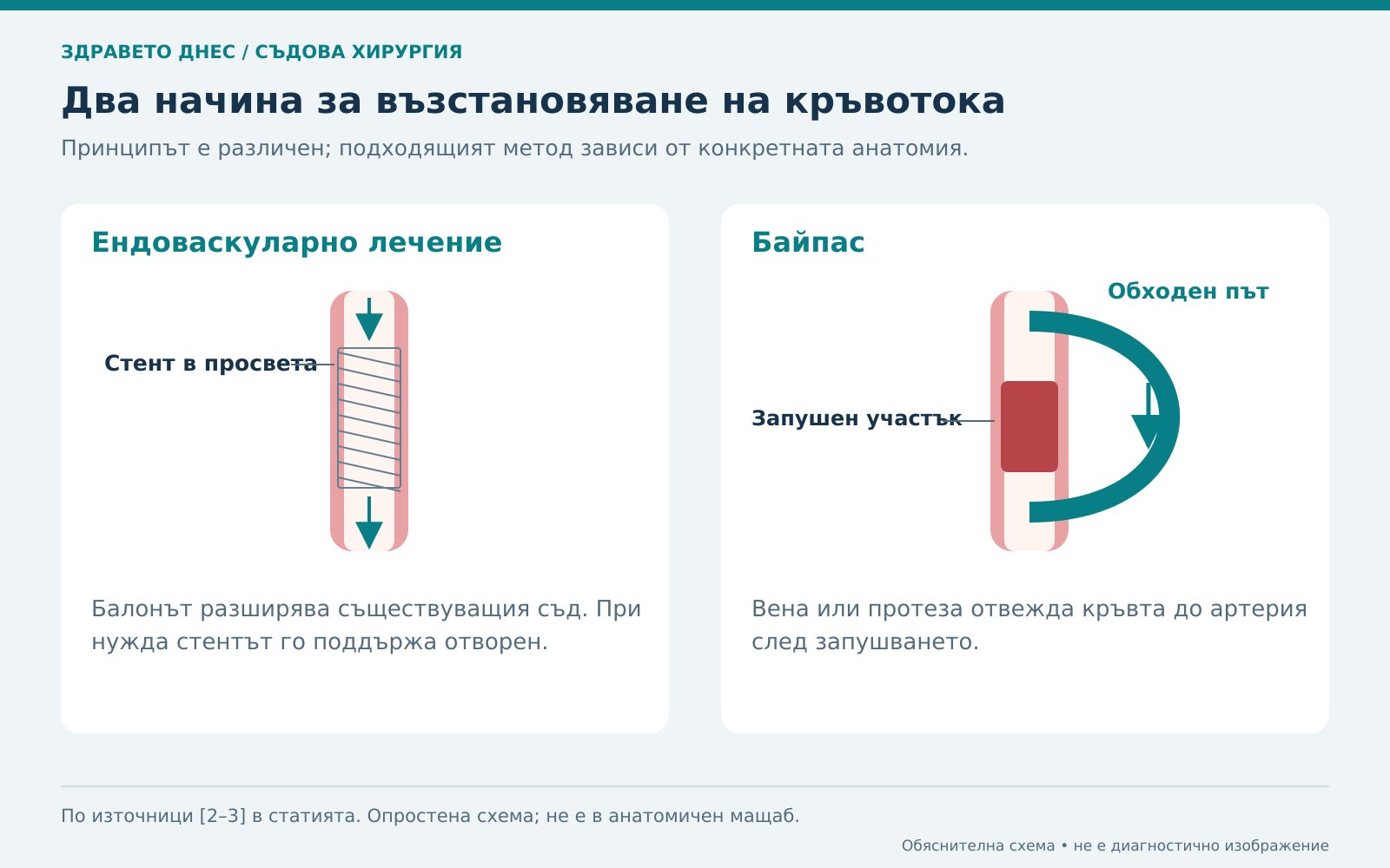Стентът отваря съществуващата артерия, а байпасът създава обходен път.