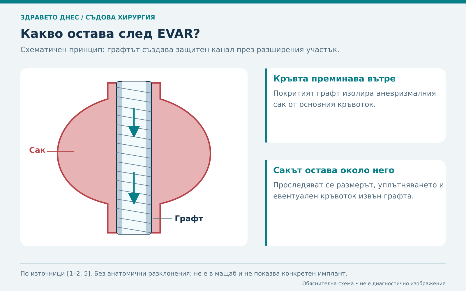 Аортният графт създава канал за кръвта, а аневризмалният сак остава около него.