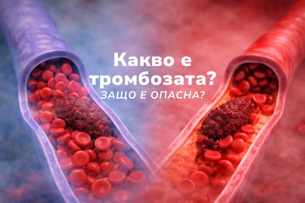 Какво представлява тромбозата и защо е опасна?