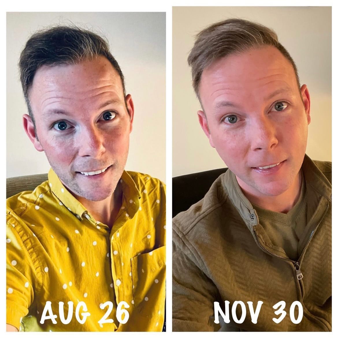 A side-by-side comparison of KP in 2021. On the left, KP wears a yellow polka-dot shirt and appears noticeably thinner due to AIDS-related wasting. On the right, taken three months later, KP looks healthier and fuller-faced, showing physical recovery.