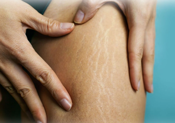 Πράγματα που Πρέπει να γνωρίζεις για την Κυτταρίτιδα