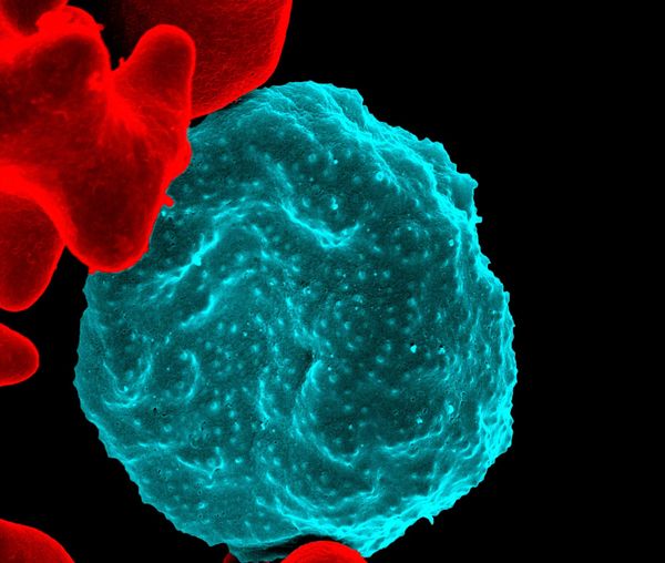 Persistent Fatigue and Weakness in Myelodysplastic Syndromes (MDS): Understanding and Managing a debilitating Symptom
