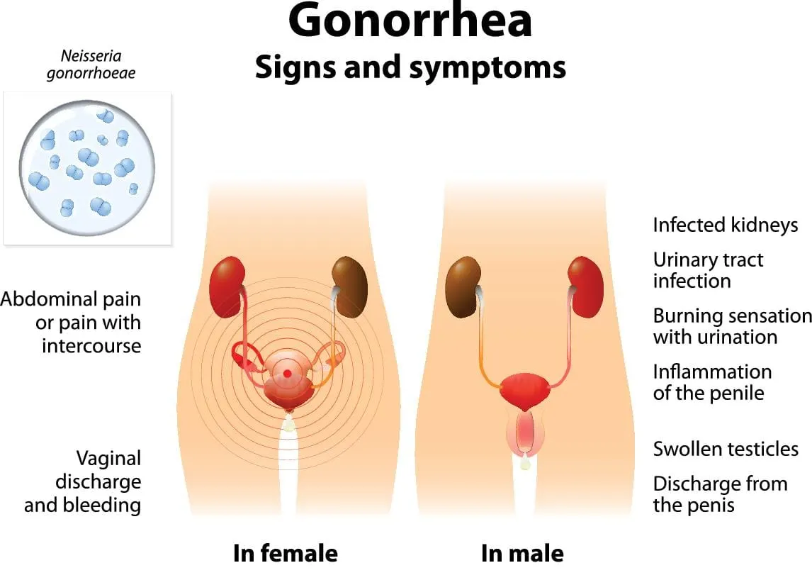 Understanding Gonorrhea: A Comprehensive Guide