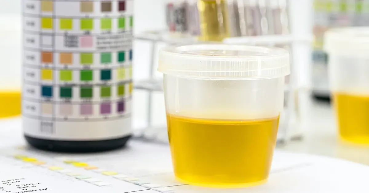 O que o odor da urina diz sobre sua saúde