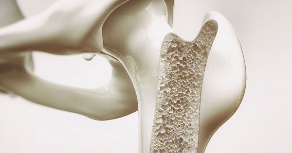 Muitas pessoas não sabem disso até sofrer uma fratura
