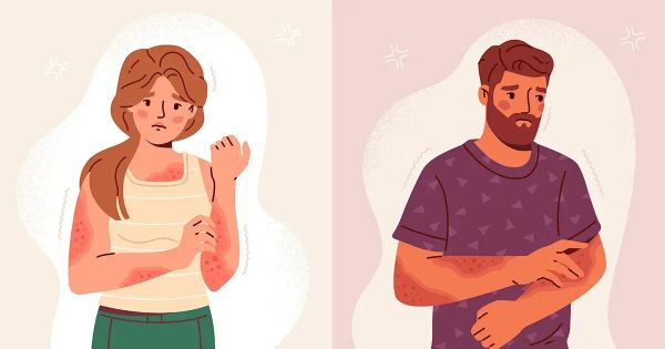 Eczema e psoríase: causas diferentes, sintomas parecidos