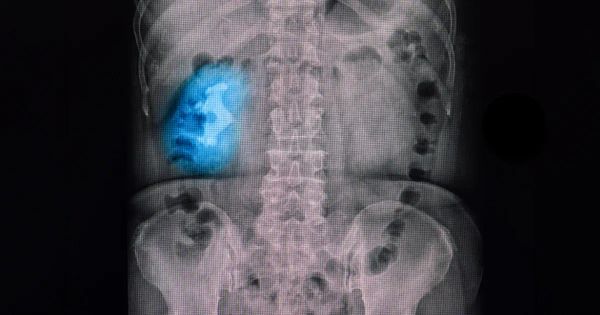 Cálculos coraliformes: o que são e como preveni-los