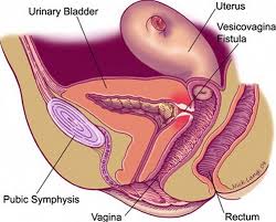 overselling the value of fistula surgery - Doctors Without Boredom