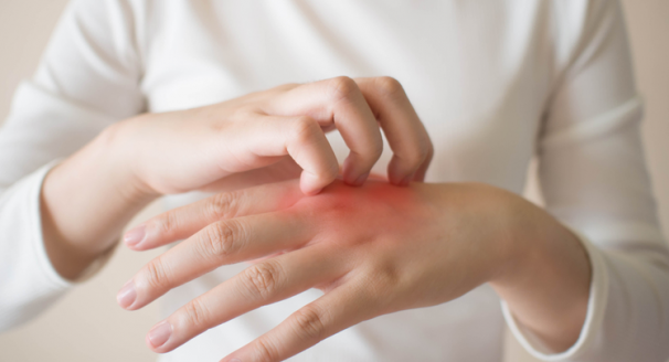 Causes of Eczema and the Latest Treatment Options