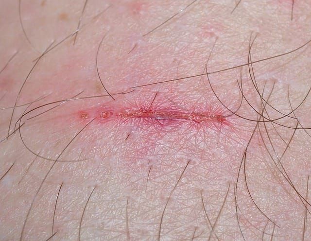 Lymphdema and Complex Wounds - Barking and Dagenham, Haverin — NHS North East London Integrated Care Board (covering Barking 