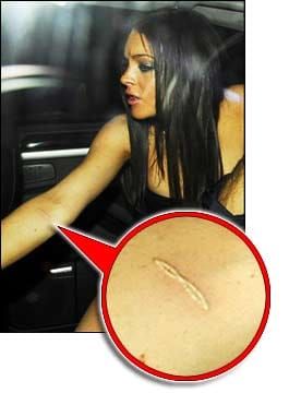 Lindsay Lohan: self harming?