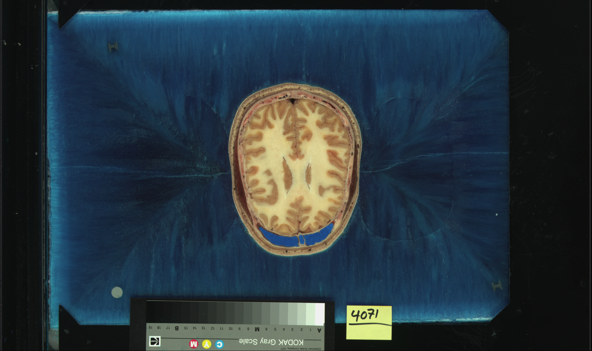 The Visible Human Project