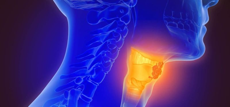 Unmasking the Hidden Threat: HPV-Related Oropharyngeal Cancer on the Rise post image
