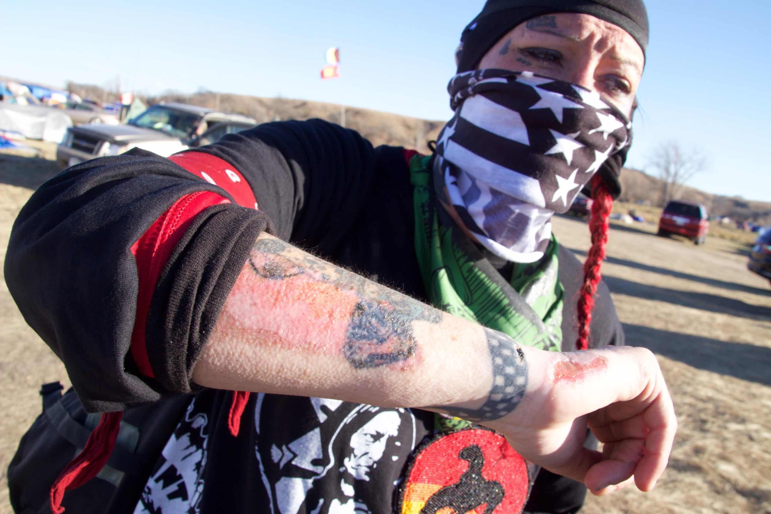 injured water protector