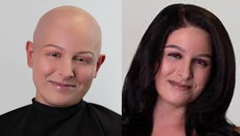 Kayla B. before and after receiving her cranial prosthesis. 