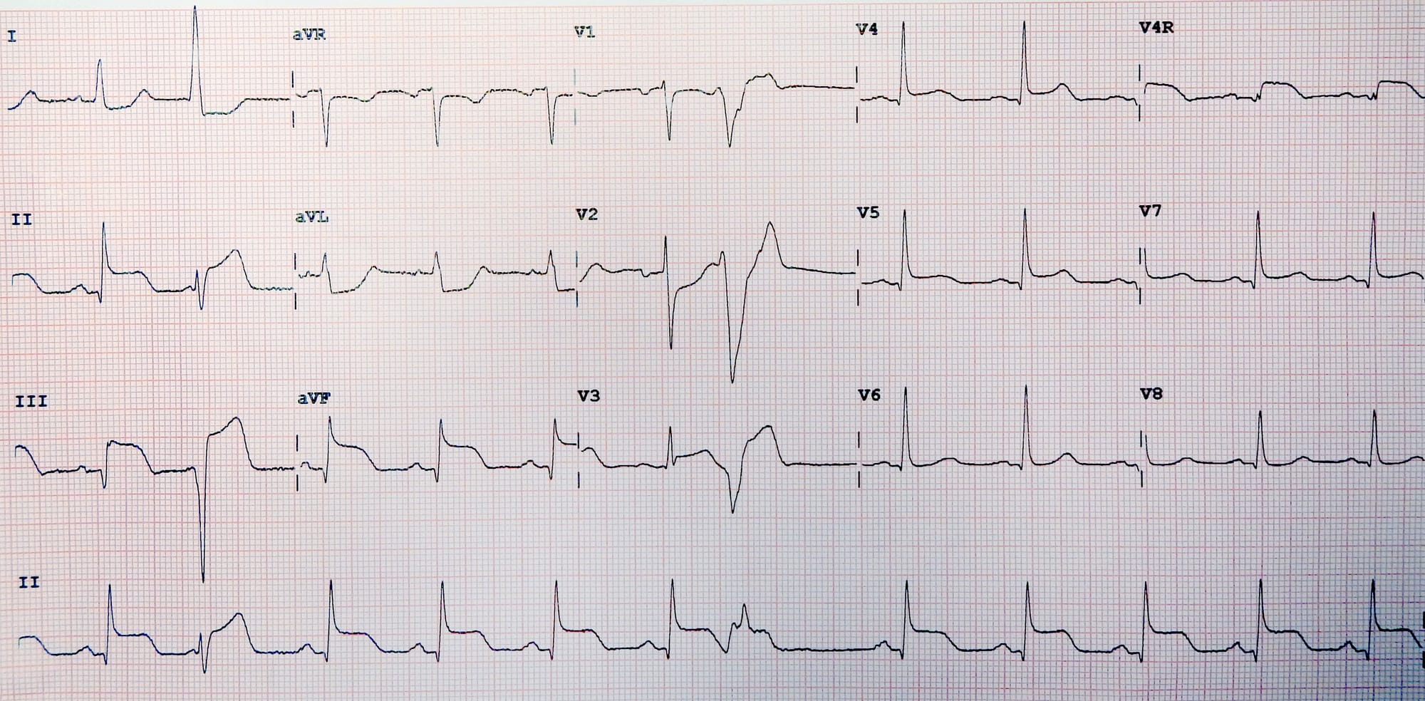Clinical ECG described by its source as inferior and right ventricular myocardial infarction, with ST elevation visible in the inferior leads and an irregular premature beat.