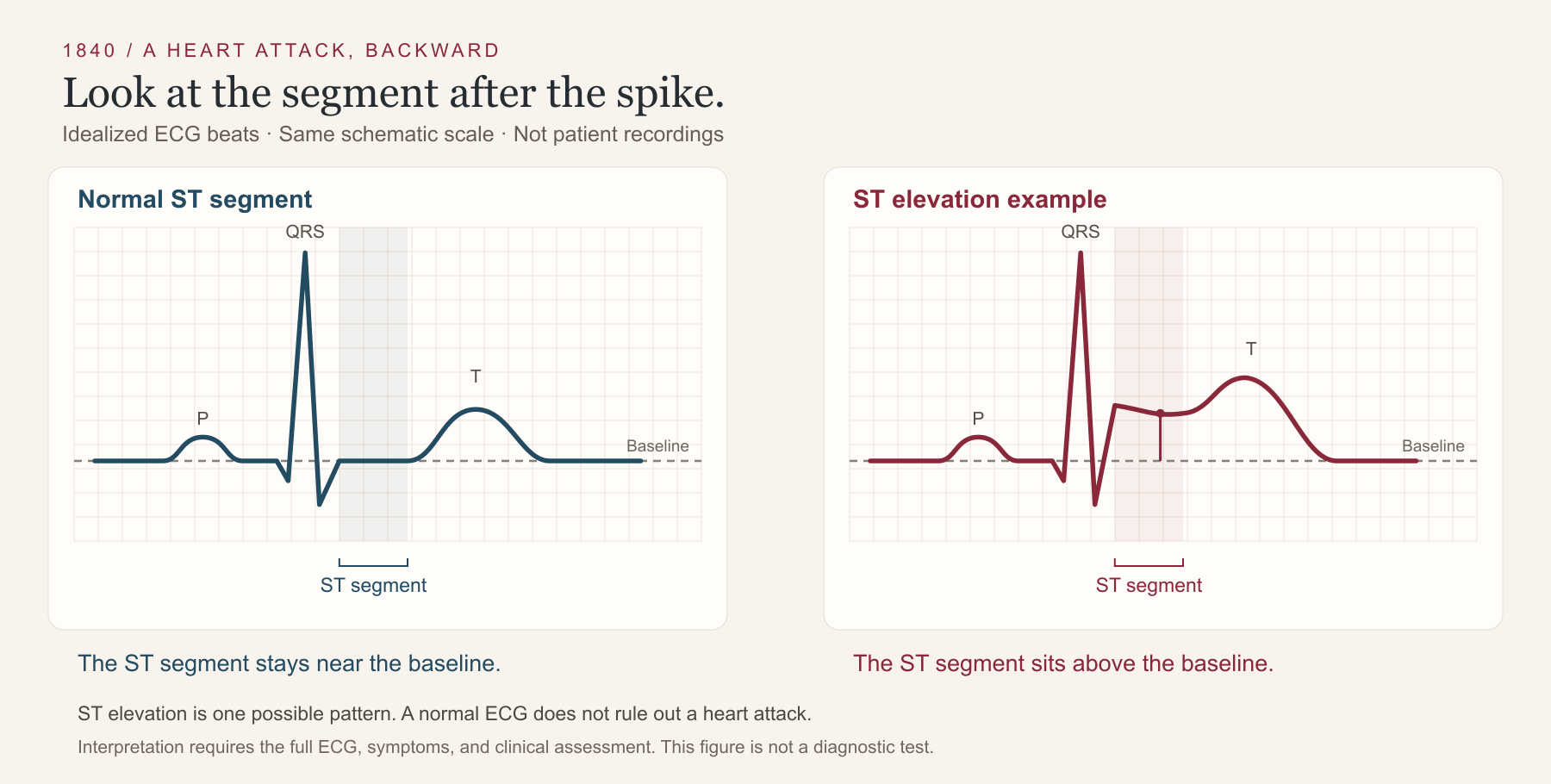 Two idealized ECG beats compare an ST segment near the baseline with an elevated ST segment. Both are teaching drawings at the same schematic scale.
