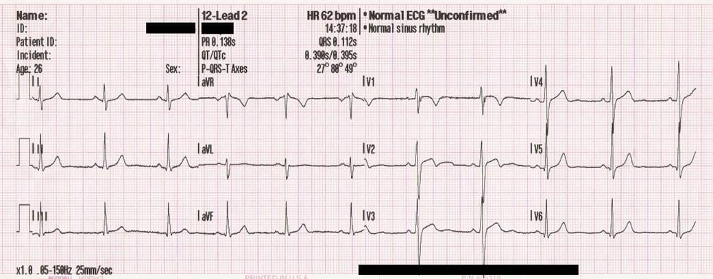 Reference 12-lead ECG from a training session, with a printed automated interpretation of normal sinus rhythm and normal ECG, marked unconfirmed.