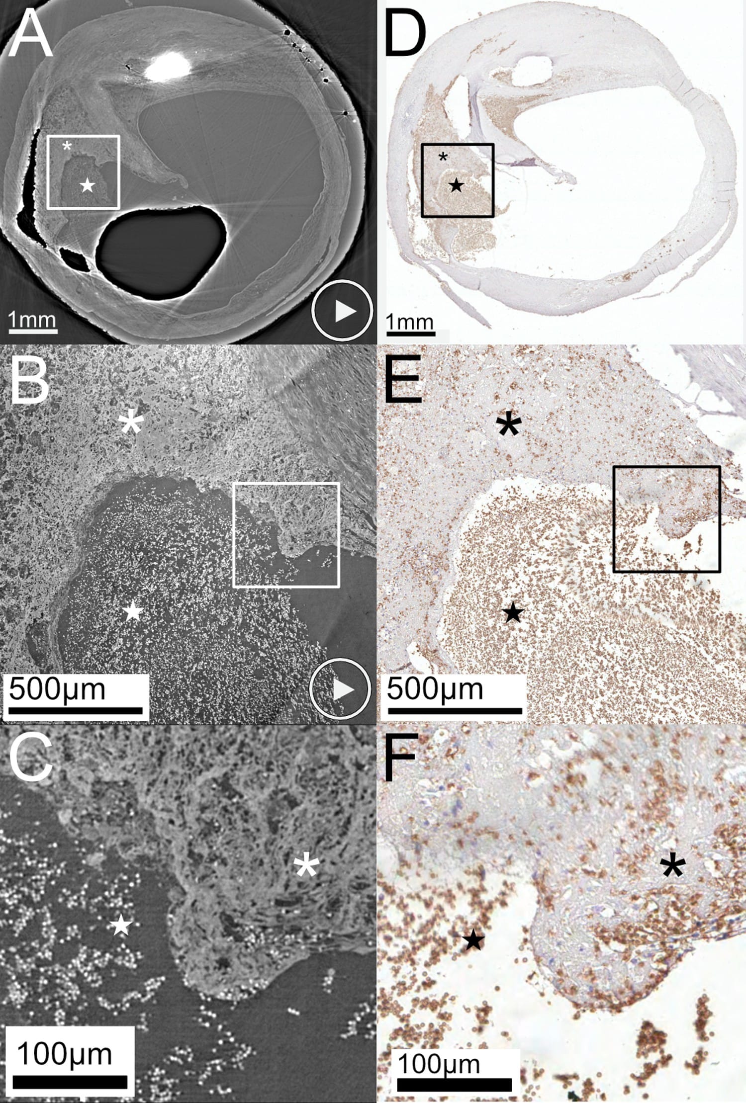Published six-panel figure of a ruptured human carotid plaque. A through C are micro-CT images; D through F are corresponding histology stained for red blood cells. Asterisks mark plaque tissue and stars mark thrombus.