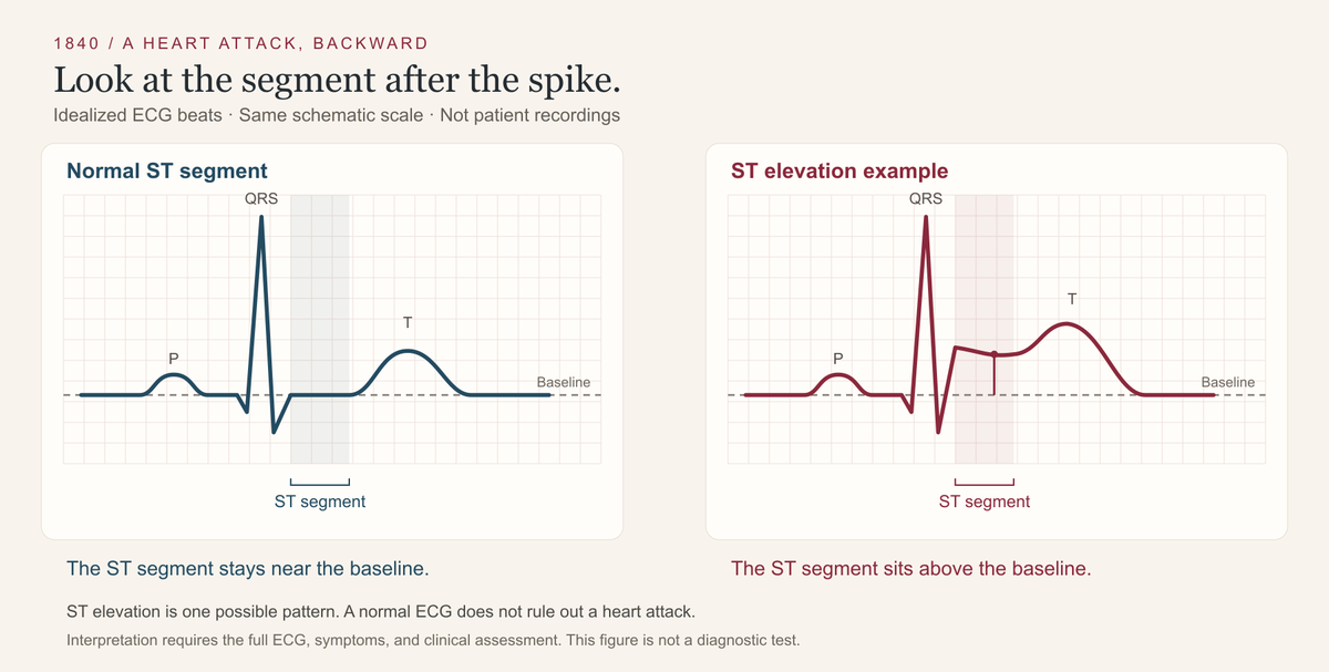 A Heart Attack, Backward — Part 1 of 4: Start with the clot.