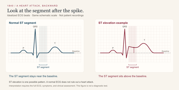 A Heart Attack, Backward — Part 1 of 4: Start with the clot.