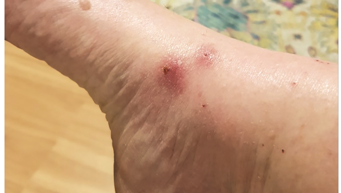 Get tested for Ross River if unwell post image