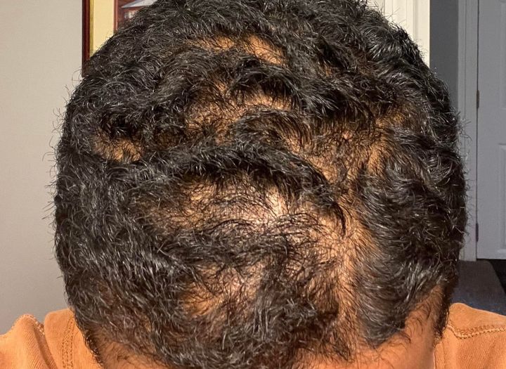 Am I Balding, Or Is It Just A Cowlick?
