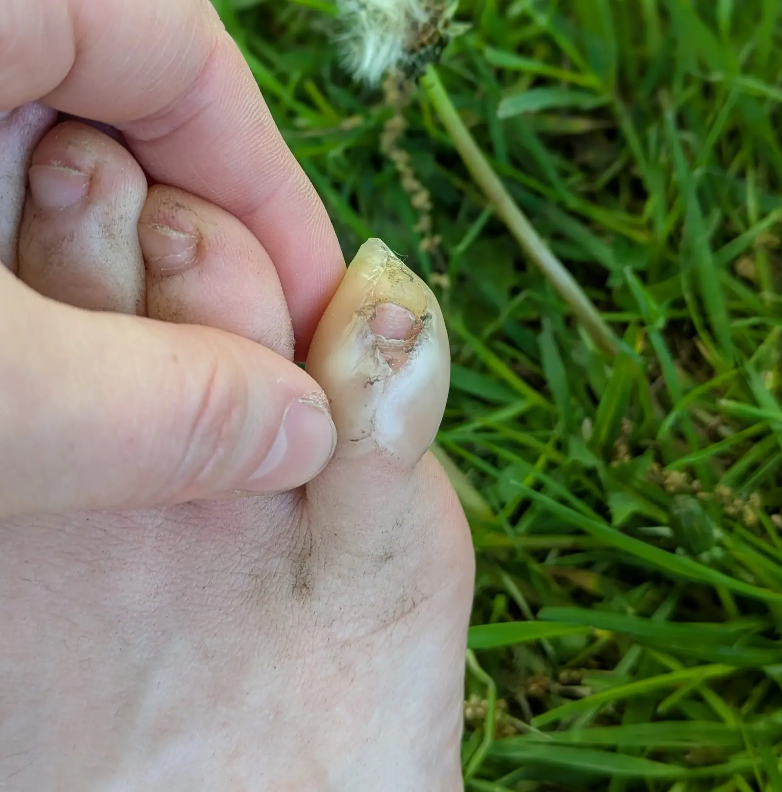 Gros plan d’un orteil au gros ongle abîmé, tenu par des doigts, sur l’herbe verte; pissenlit flou au fond.