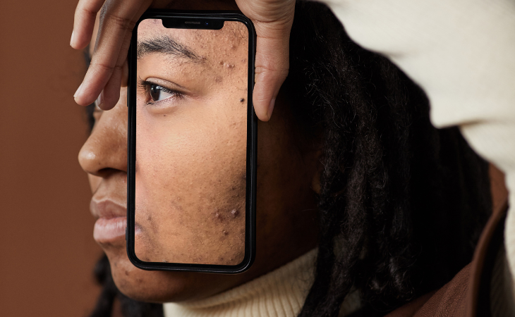 La cicatrisation de mes marques d'acné