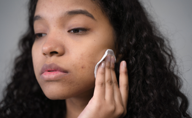 Image de : L'acné kystique