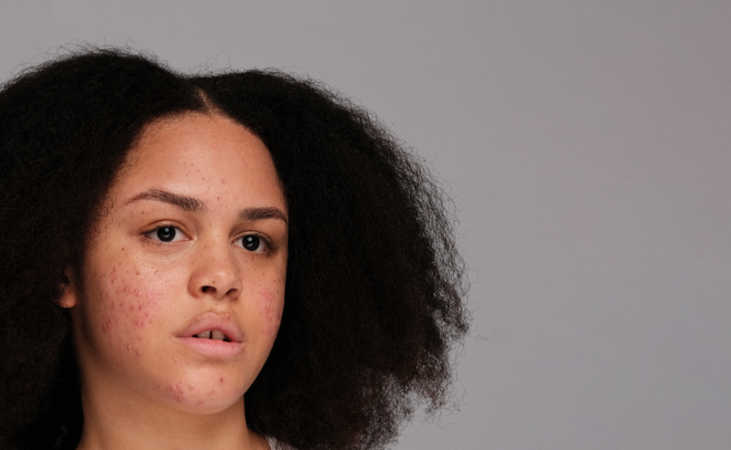 Image de : La purge cutanée