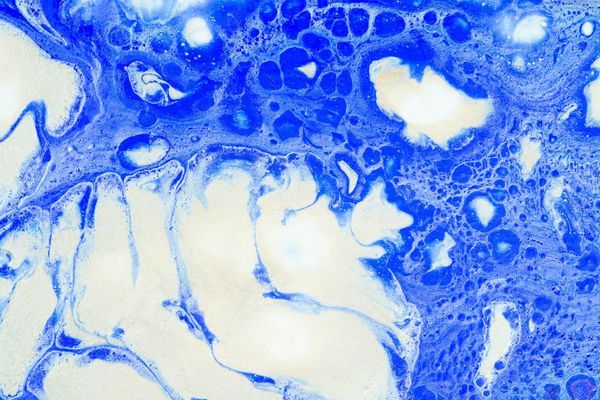 Liquid and Solid Tumours