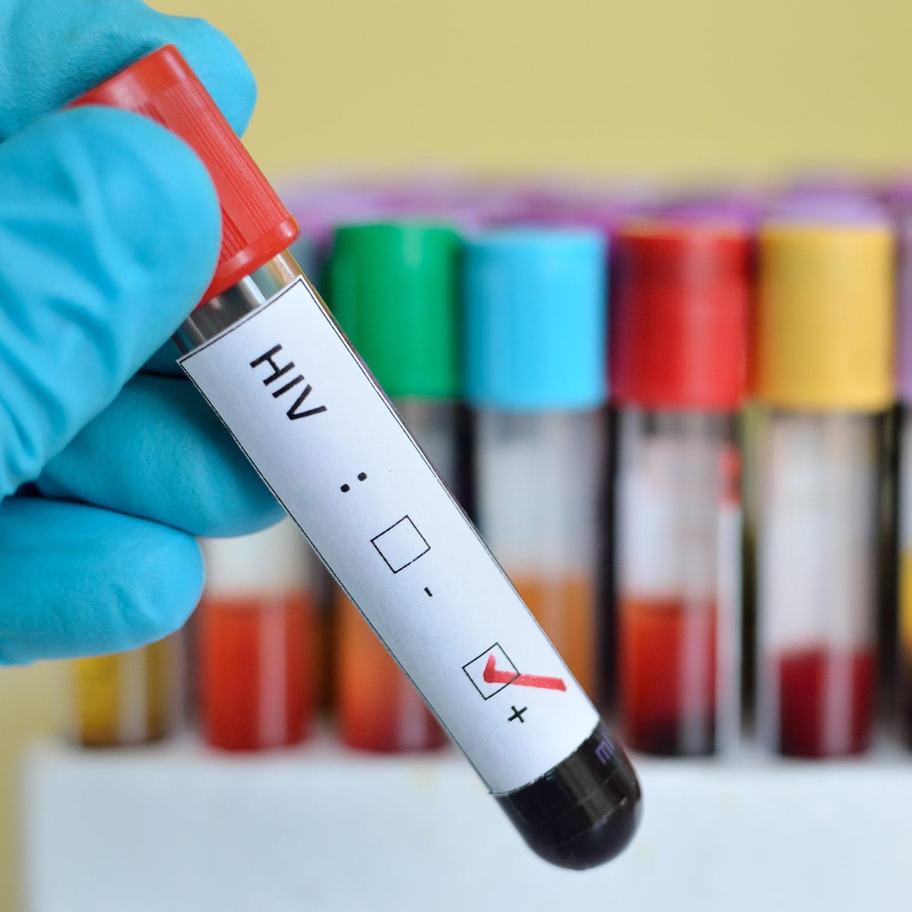 An end to AIDS in Australia